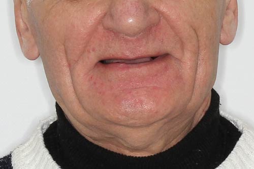 Пример протезирования зубов №3