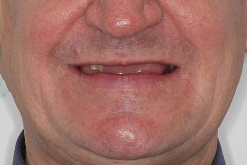 Пример протезирования зубов №2