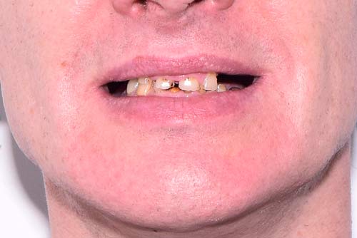 Пример протезирования зубов №10