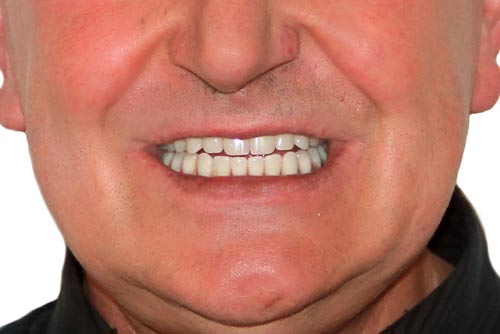 Пример протезирования зубов №9