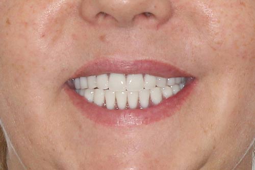 Пример протезирования зубов №8