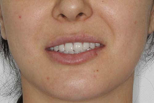 Пример протезирования зубов №6