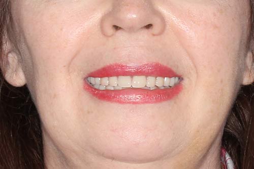 Пример протезирования зубов №5