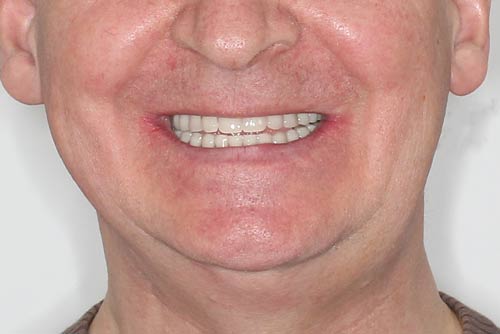 Пример протезирования зубов №1
