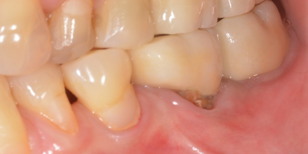 прикорневой кариес нижнего зуба