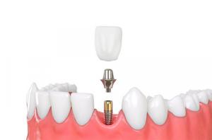двухсоставные зубные импланты