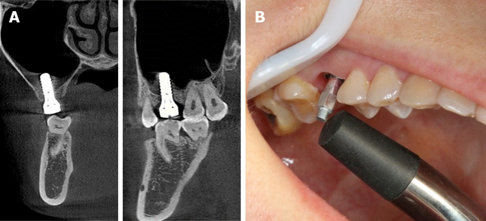 этап установки зубных имплантов