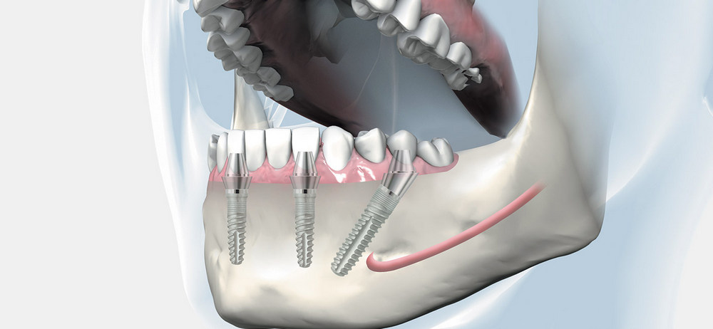 имплантация всех зубов