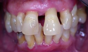 восстановление зубов при пародонтите