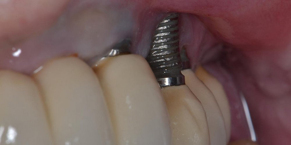 Как выглядит периимплантит зубов
