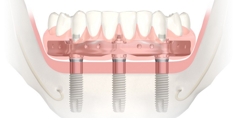 Имплантация на трех зубных имплантах