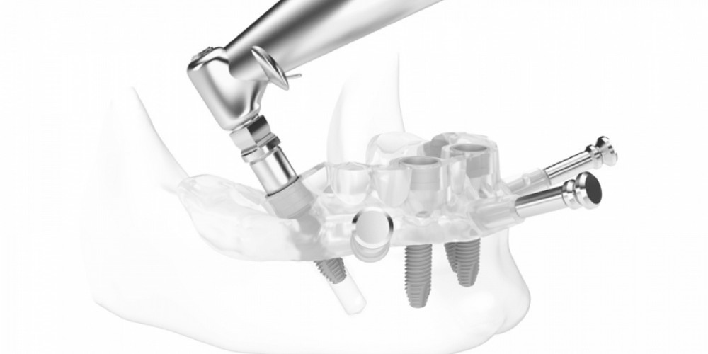 Применение хирургического шаблона в имплантации зубов